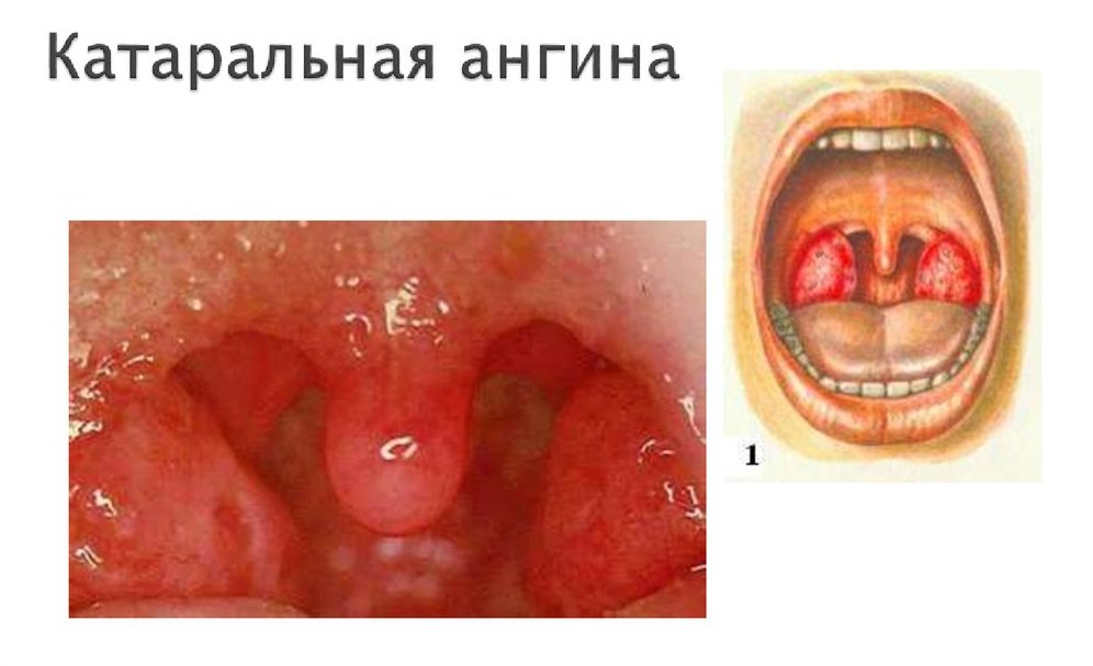 Катаральная ангина: причины, симптомы, лечение