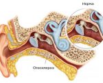 Отосклероз (Отоспонгиоз): симптомы и лечение