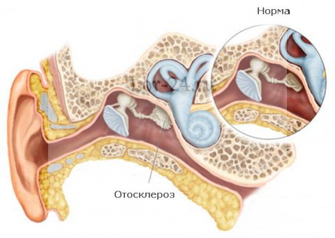 Что такое отосклероз и как он развивается?
