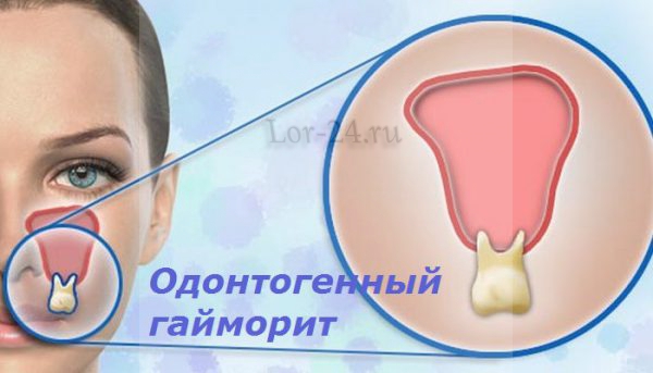 Одонтогенный гайморит
