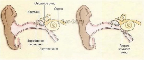 Что происходит в ухе после баротравмы
