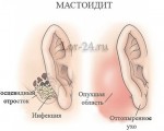 Мастоидит: причины, симптомы, диагностика и лечение
