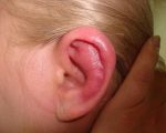 Перихондрит — воспаление хряща ушной раковины: симптомы и лечение
