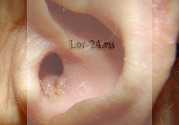 Эпидермальный стафилококк в ушах 12