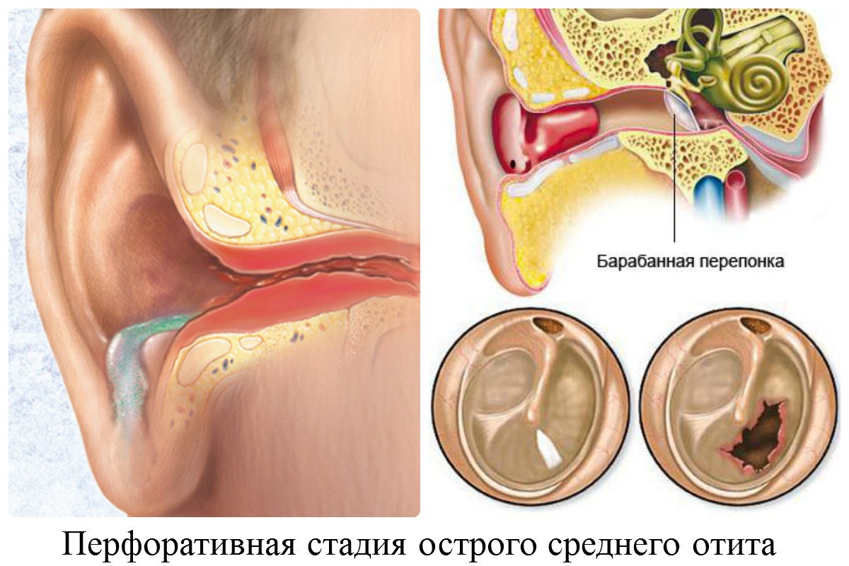 Острые гнойные заболевания уха отит