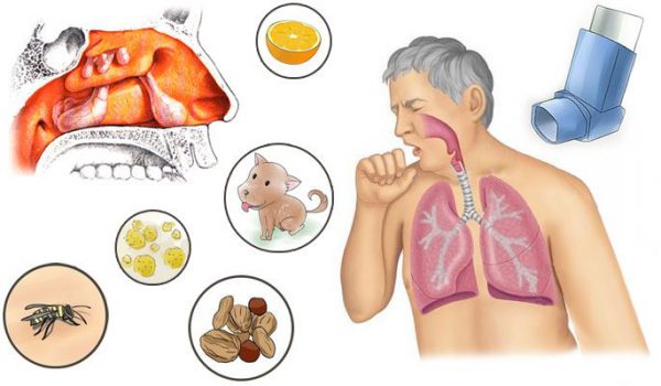 Воспаление пазух носа при аллергии thumbnail