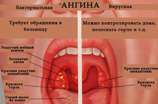 Антибиотик при гортанной ангине thumbnail