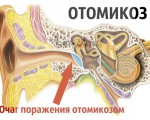 Что такое отомикоз (грибок в ушах) и почему он развивается?