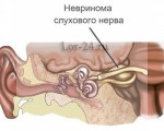 Невринома слухового нерва: механизм развития, причины и лечение
