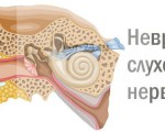 Как и почему появляется неврит слухового нерва