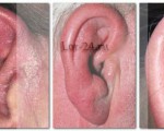 Рожистое воспаление ушной раковины: механизм развития, причины и методы лечения
