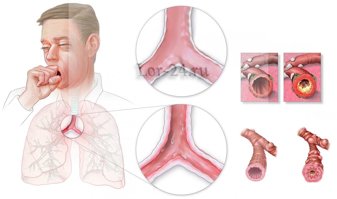 Признаки заболевания бронхитом. Острый трахеит острый бронхит. Хронический бронхит дыхание. Поражение бронхов острый бронхит. Бронхит трахеит ларингит.