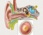 Симптомы и лечение болезней среднего уха