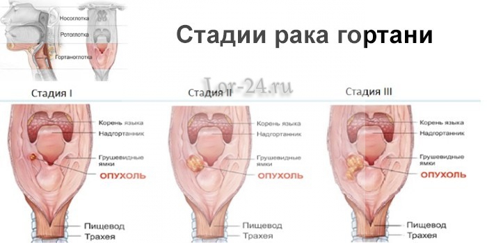 Рак Гортани Секс